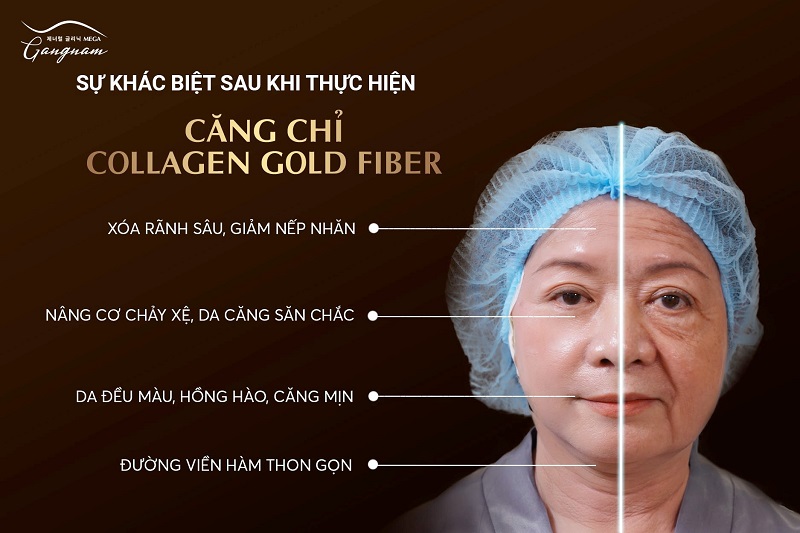 Phòng khám Mega Gangnam Căng chỉ Collagen trẻ hóa làn da