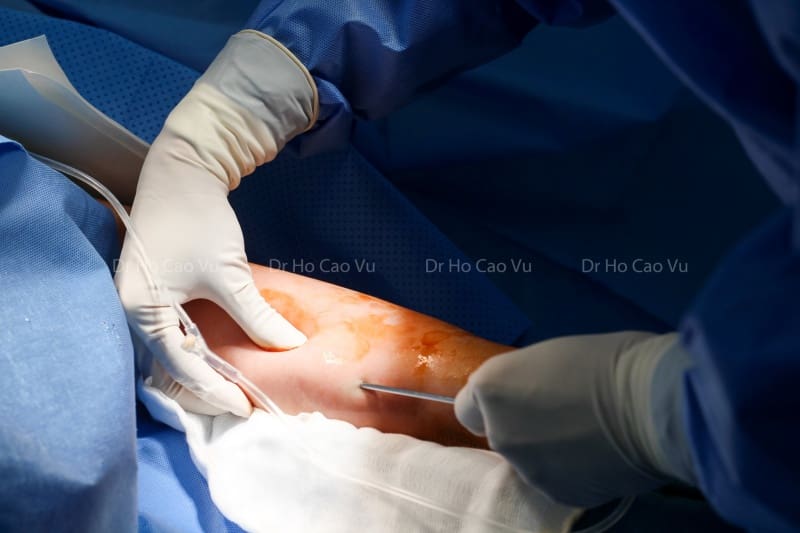 Hút mỡ bắp tay bị lồi lõm và những gì bạn cần biết