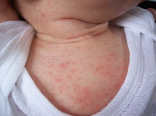 Bé bất ngờ bị rôm sảy mùa đông, nguyên nhân do đâu?