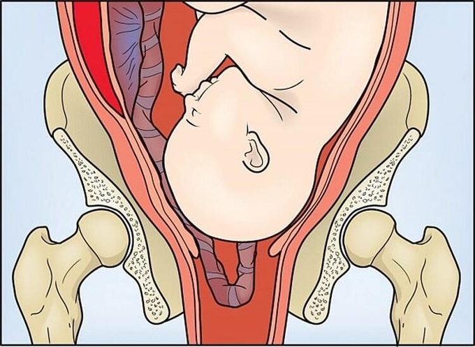 Sa dây rốn - biến chứng nguy hiểm cuối thai kỳ