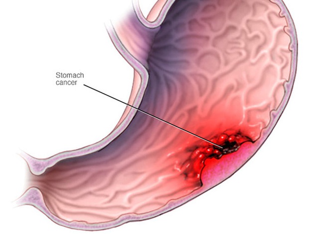 Ung thư dạ dày xuất phát từ những tổn thương tiềm tàng này