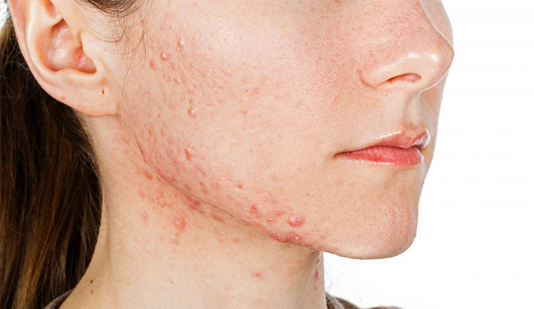 Xử trí mụn trứng cá