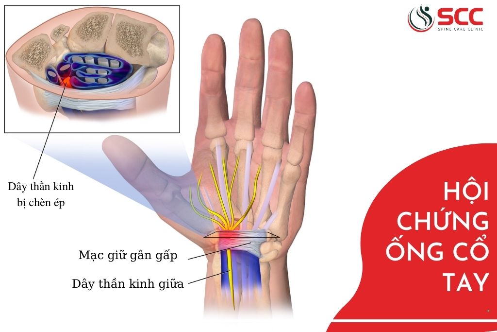 Đau tê - dấu hiệu hội chứng ống cổ tay