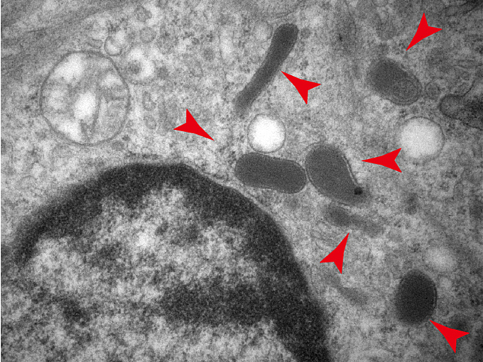 Phát hiện nguyên nhân khiến ung thư di căn