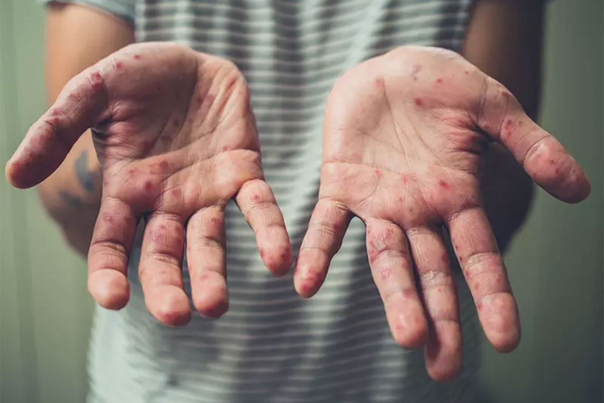 Người lớn mắc bệnh tay chân miệng có nguy hiểm không?