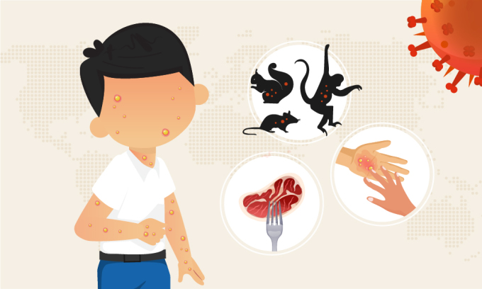 Ca đậu mùa khỉ thứ hai ở Việt Nam