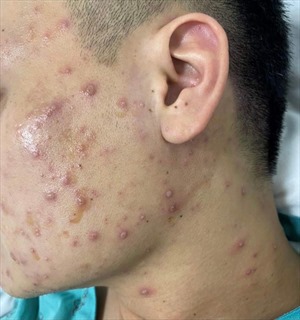 Chăm sóc người mắc bệnh thuỷ đậu thế nào để tránh biến chứng