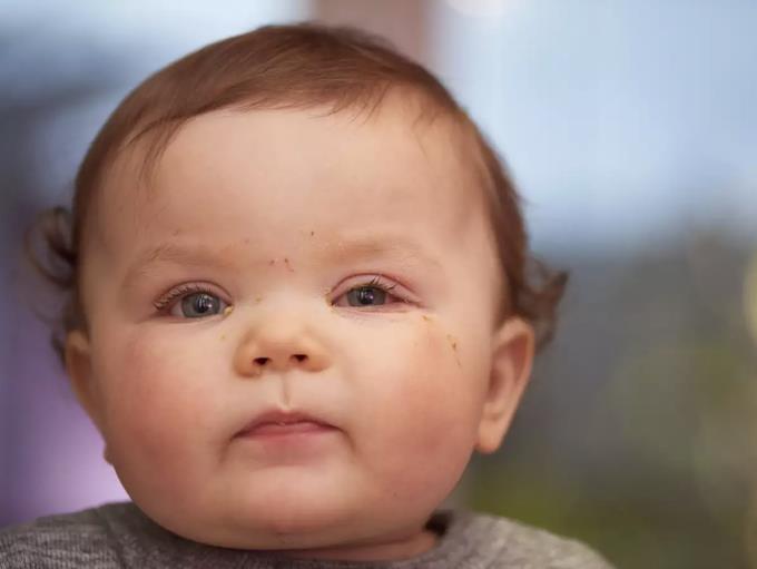 Đau mắt đỏ - triệu chứng mắc Covid mới