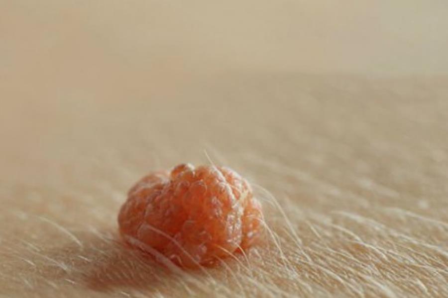 Mụn cóc sinh dục - bệnh dễ mắc nhưng ngại đi khám