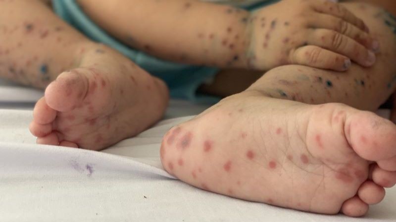 Bộ Y tế thông tin về thuốc điều trị bệnh tay chân miệng