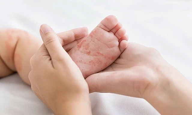 Cách xử trí và giảm tác nhân dị ứng ở trẻ