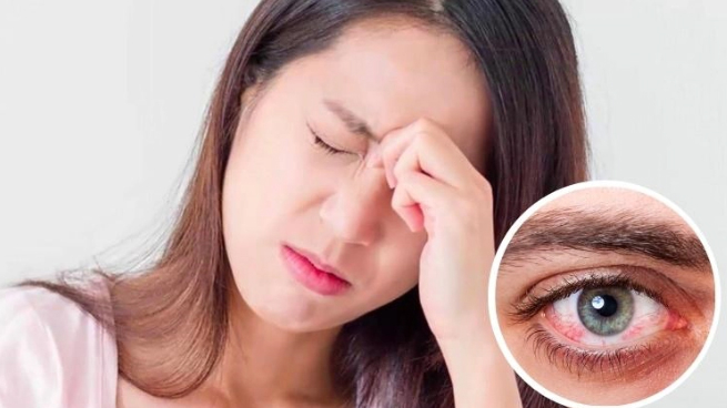 3 biểu hiện của viêm kết mạc mùa xuân