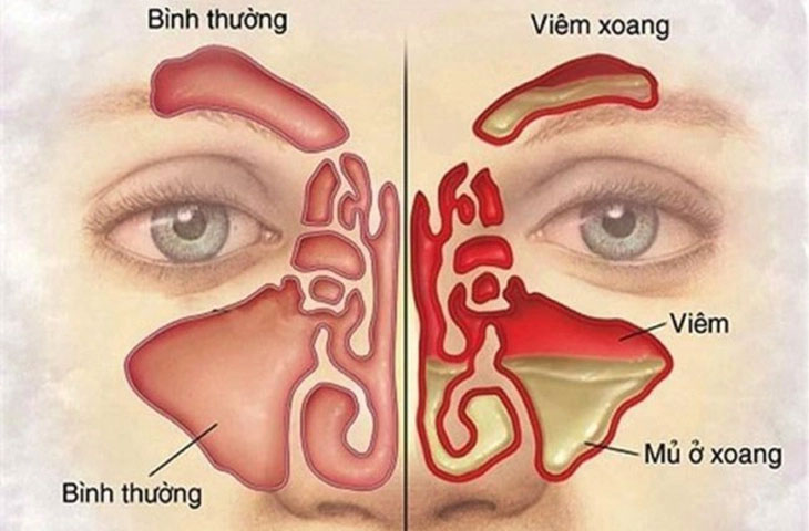 Viêm xoang có gây đau hốc mắt?