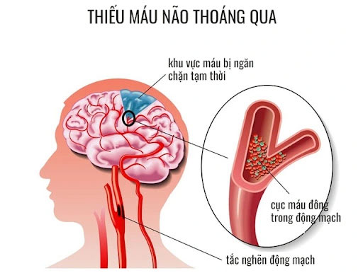 Thiếu máu não thoáng qua làm sao phân biệt với bệnh lý khác?