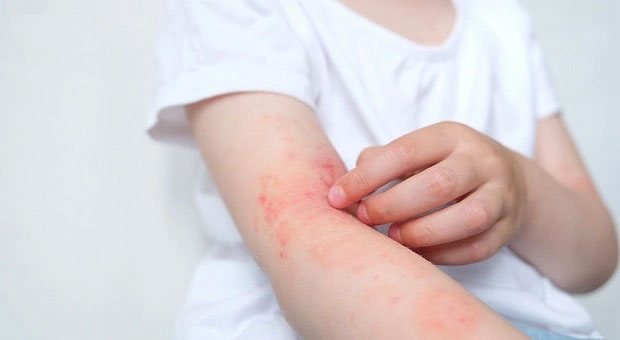 Những biến chứng của viêm da dị ứng