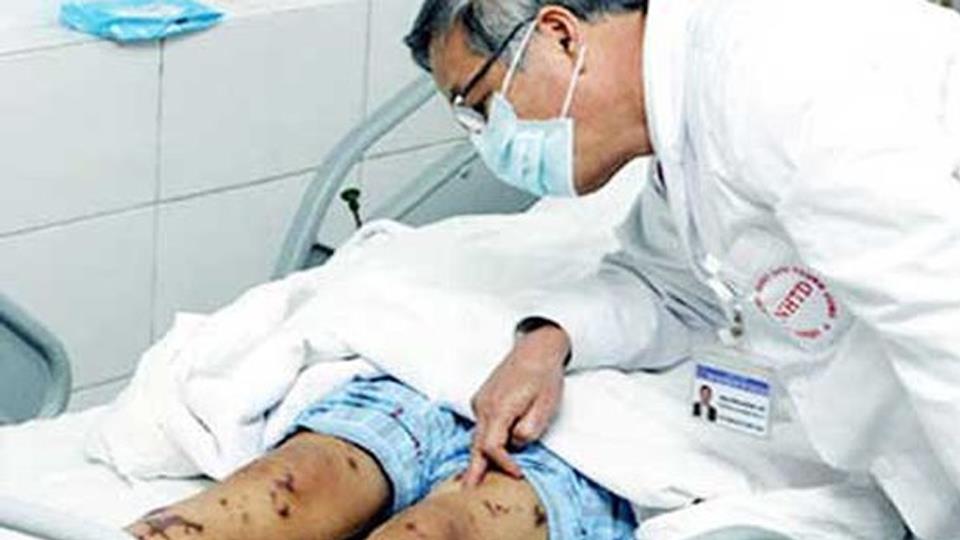 Bộ Y tế khuyến cáo các biện pháp phòng lây nhiễm liên cầu lợn sang người