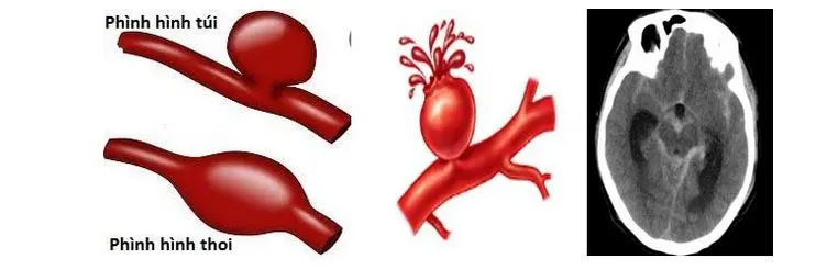 Phình mạch máu não phát hiện bằng cách nào?