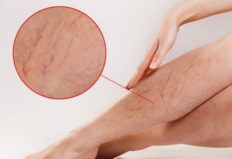 6 dấu hiệu cảnh báo suy giãn tĩnh mạch chân