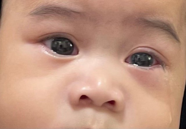 Căn bệnh dễ lây qua nước mắt, gỉ mắt, phòng tránh thế nào?