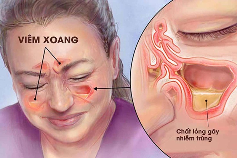 Người bị viêm xoang cấp cần lưu ý những gì?