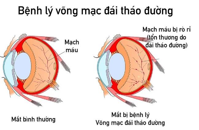 Xét nghiệm chẩn đoán bệnh võng mạc tiểu đường