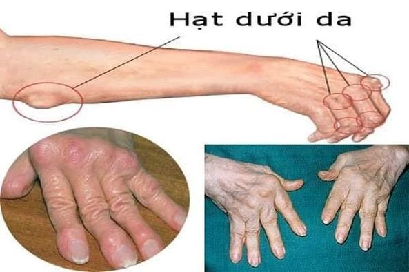 Điều trị sớm viêm khớp dạng thấp để tránh tàn phế