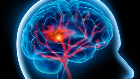 Bệnh xuất huyết não