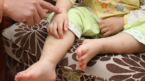 Hồng ban nút- hậu quả của nhiều bệnh