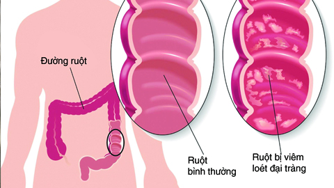 Viêm đại tràng mạn tính: Dễ mắc nhưng khó chữa