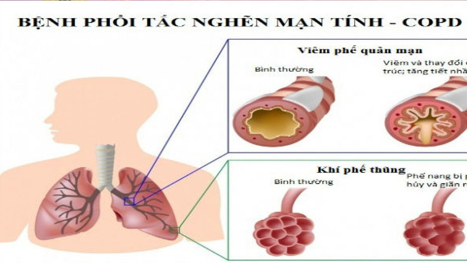 Bệnh phổi tắc nghẽn mạn tính - Những điều cần biết