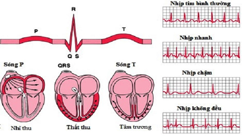 Ðau tim thầm lặng - Cách nhận biết và ứng phó