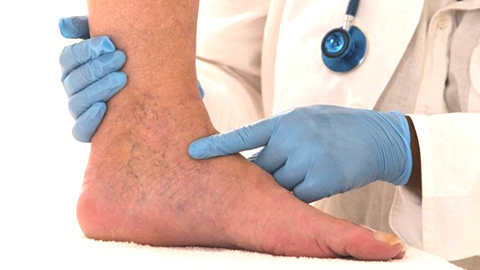 Suy tĩnh mạch mạn tính chi dưới - không thể chủ quan