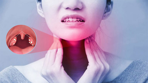 Viêm amidan, khi nào cần cắt?