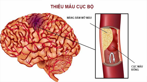 Cách phát hiện "kẻ thù nguy hiểm"- Cục máu đông