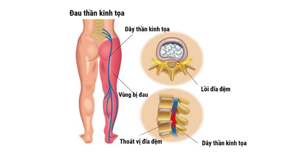 Bài thuốc trị đau thần kinh tọa