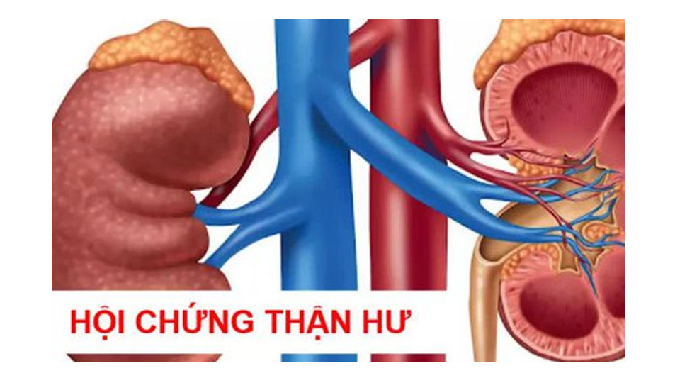 Hội chứng thận hư ở người lớn có nguy hiểm?